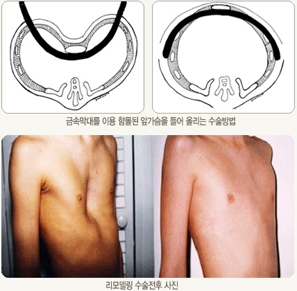 심장혈관흉부외과+_리모델링+수술법.jpg